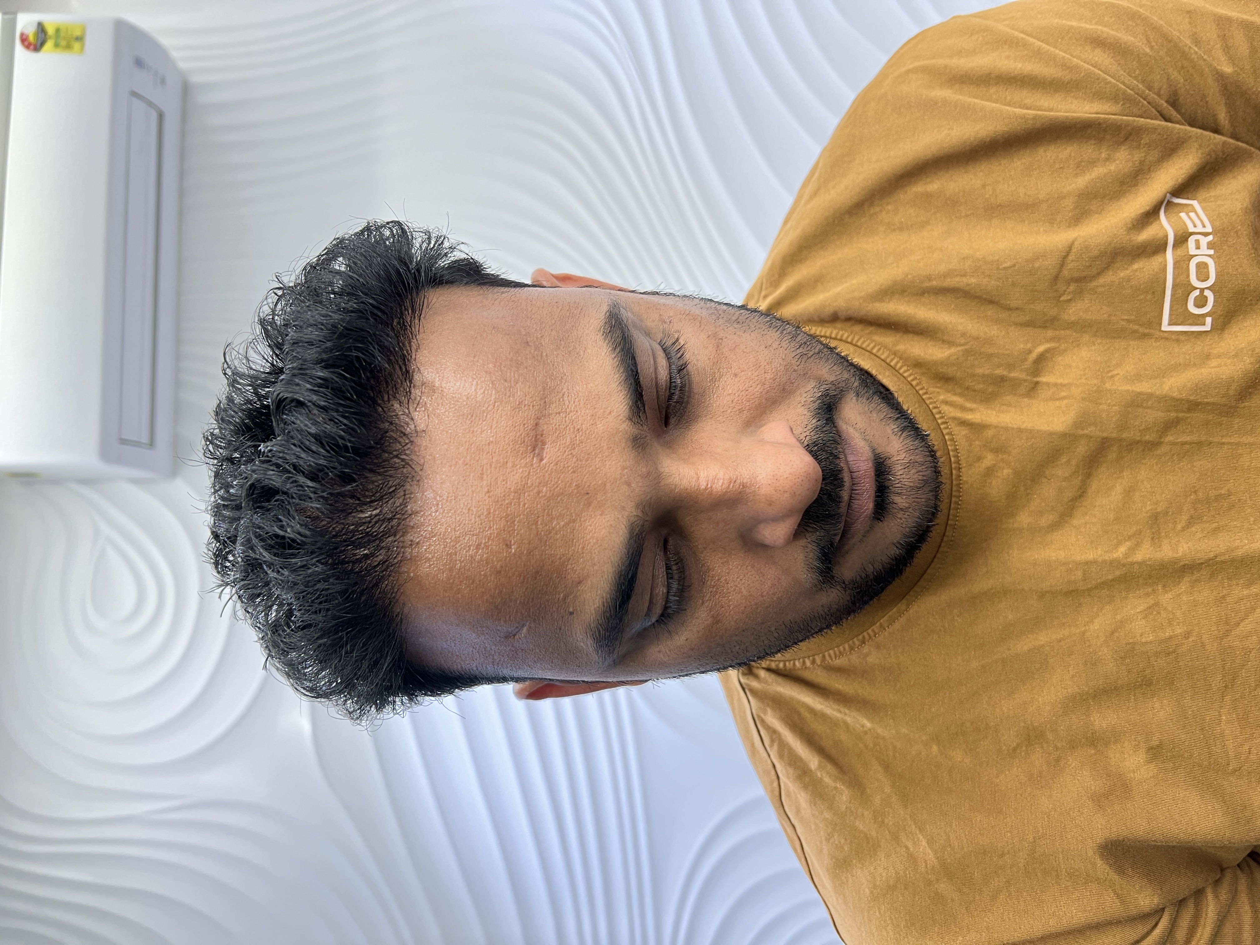 hair transplant results