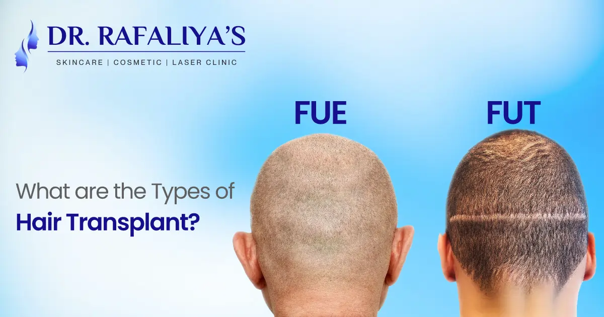 Types of Hair Transplant