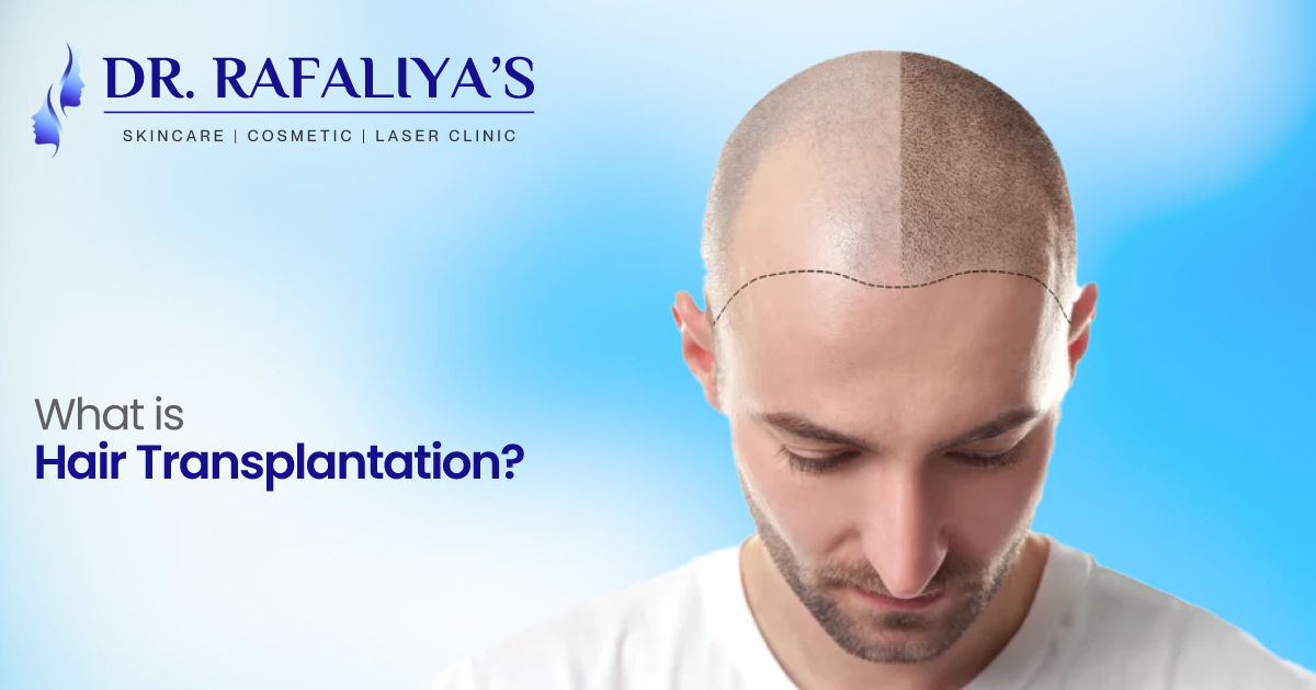 What is Hair Transplantation